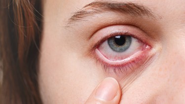 Bạch hầu ở mắt: Nguyên nhân, dấu hiệu, điều trị và phòng ngừa