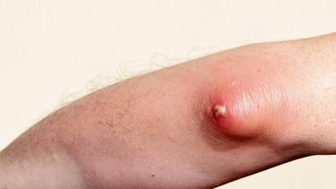 Áp xe da: Dấu hiệu, nguyên nhân, phương pháp chẩn đoán, điều trị và phòng ngừa