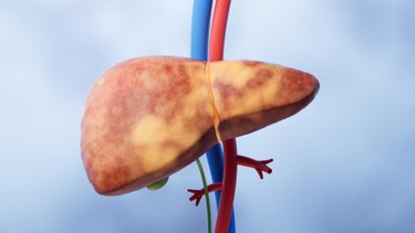 Bệnh nang gan là gì? Nguyên nhân, triệu chứng và cách điều trị