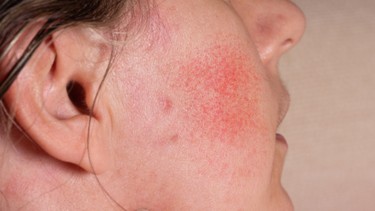 Bệnh Rosacea: Dấu hiệu, nguyên nhân, phương pháp chẩn đoán, điều trị và phòng ngừa