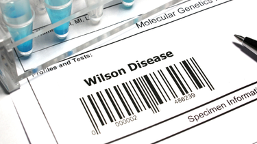Bệnh Wilson là gì? Triệu chứng, nguyên nhân, cách điều trị và phòng ngừa