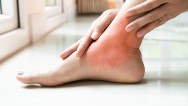 Bong gân là gì? Nguyên nhân, triệu chứng và cách điều trị