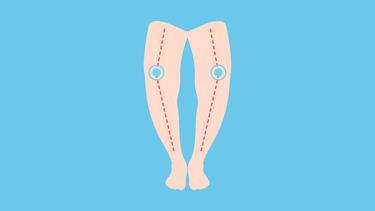 Chân vòng kiềng là gì? Nguyên nhân, cách điều trị và phòng ngừa