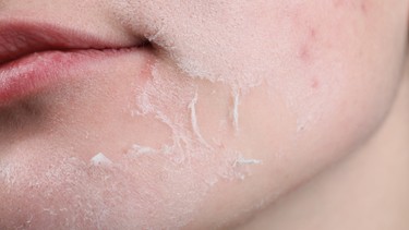 Da khô là gì? Triệu chứng, nguyên nhân, chẩn đoán và điều trị hiệu quả