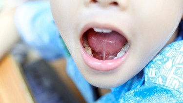 Dính thắng lưỡi là gì? Những vấn đề cần biết về dính thắng lưỡi