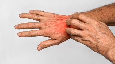 Bệnh ghẻ là gì? Những vấn đề cần biết về bệnh ghẻ