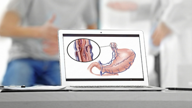 Giãn tĩnh mạch thực quản là gì? Triệu chứng, nguyên nhân và cách điều trị