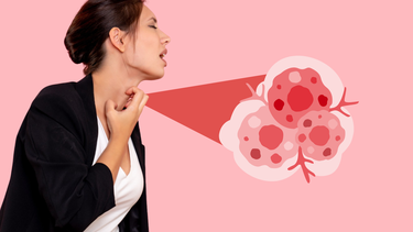 Hạt xơ thanh quản​ là gì? Triệu chứng, nguyên nhân và cách điều trị