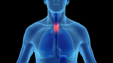 Hẹp thực quản là gì? Triệu chứng, nguyên nhân và cách điều trị