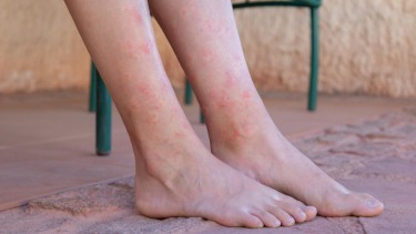 Hồng ban nút là gì? Nguyên nhân, triệu chứng và phương pháp điều trị