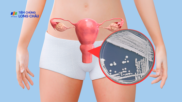 Nấm âm đạo là gì? Nguyên nhân, triệu chứng và điều trị