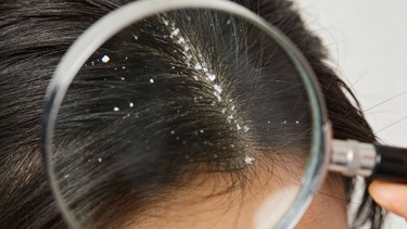 Nấm da đầu: Dấu hiệu thường gặp và cách xử lý hiệu quả