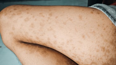 Nấm da là gì? Những điều cần biết về nấm da