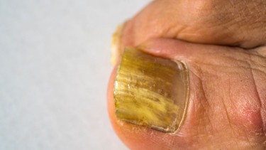 Nâm móng là gì? Những điều cần biết về nấm móng