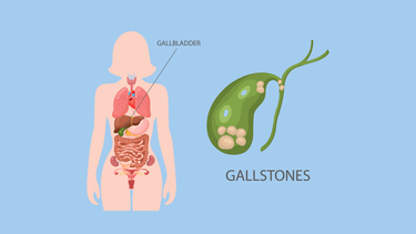 Sỏi túi mật là gì? Triệu chứng, nguyên nhân và cách điều trị