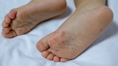 Tay chân miệng là gì? Nguyên nhân gây bệnh và cách phòng ngừa hiệu quả