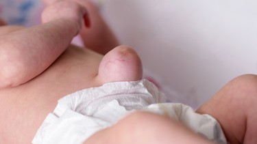 Thoát vị rốn là gì? Những điều cần biết về thoát vị rốn