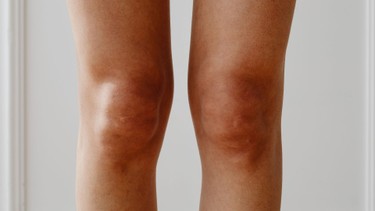 Tràn dịch khớp gối là gì? Những vấn đề cần biết về tràn dịch khớp gối