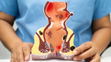 Bệnh trĩ là gì? Những điều cần biết về bệnh trĩ