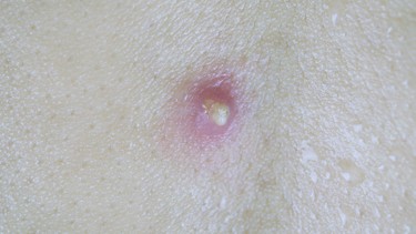 U bã đậu: Dấu hiệu, nguyên nhân, phương pháp chẩn đoán, điều trị và phòng ngừa