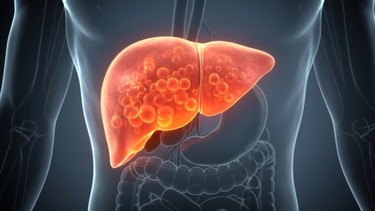 U gan đa ổ​ là gì? Nguyên nhân, triệu chứng và cách điều trị