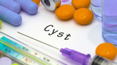 U nang là gì? Triệu chứng, nguyên nhân, phương pháp chẩn đoán và điều trị