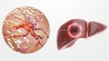 U nguyên bào gan​ là gì? Nguyên nhân, triệu chứng và cách điều trị