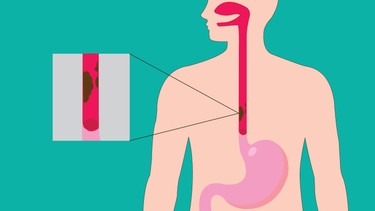 Ung thư thực quản là gì? Nguyên nhân, triệu chứng và cách điều trị