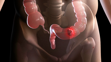 Ung thư trực tràng​ là gì? Nguyên nhân, triệu chứng và cách điều trị