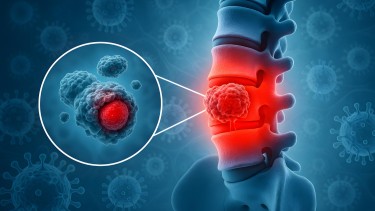Ung thư xương là gì? Nguyên nhân, triệu chứng và cách điều trị