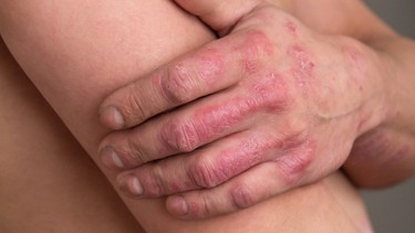 Bệnh vảy nến là gì? Triệu chứng, nguyên nhân, phương pháp chẩn đoán và điều trị hiệu quả