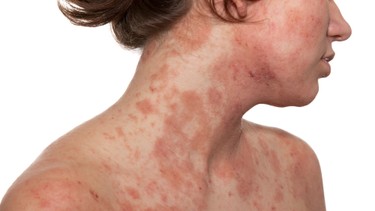 Vảy phấn hồng là gì? Những điều cần biết về vảy phấn hồng