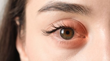 Viêm bờ mi: Nguyên nhân gây bệnh và phương pháp điều trị, phòng ngừa hiệu quả