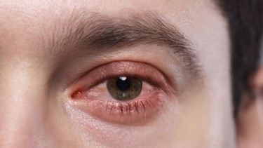 Viêm giác mạc là gì? Nguyên nhân và cách phòng ngừa hiệu quả