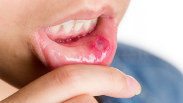 Viêm niêm mạc: Dấu hiệu, nguyên nhân, phương pháp chẩn đoán, điều trị và phòng ngừa