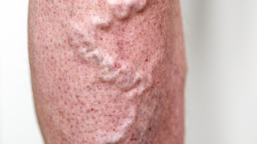 Viêm tĩnh mạch là gì? Dấu hiệu, nguyên nhân, cách điều trị và phòng ngừa