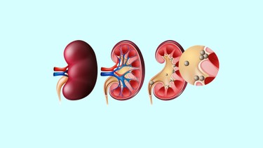 Vôi hóa thận là gì? Nguyên nhân và cách phòng ngừa hiệu quả