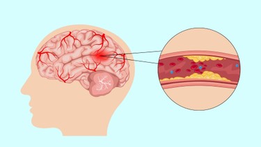 Xơ vữa động mạch cảnh: Dấu hiệu, nguyên nhân, phương pháp chẩn đoán, điều trị và phòng ngừa
