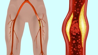Xơ vữa động mạch chi dưới: Dấu hiệu, nguyên nhân, phương pháp chẩn đoán, điều trị và phòng ngừa