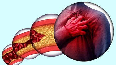 Xơ vữa động mạch vành là gì? Nguyên nhân và cách phòng ngừa hiệu quả