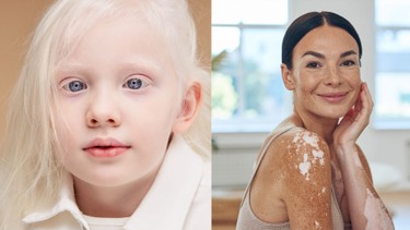 Bệnh bạch tạng và bạch biến: Cách phân biệt chính xác, tránh nhầm lẫn