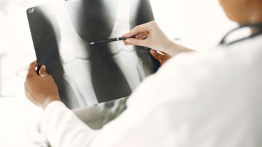 Bệnh còi xương: Triệu chứng, nguy cơ, cách điều trị và phòng ngừa