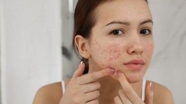 Định nghĩa bệnh da liễu và các bệnh da liễu thường gặp