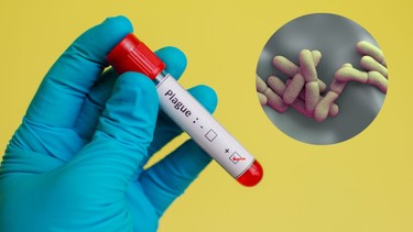 Bệnh dịch hạch: Nguyên nhân, dấu hiệu và phương pháp điều trị