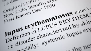 Bệnh lupus ban đỏ giai đoạn đầu: Dấu hiệu, chẩn đoán và điều trị