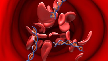 Bệnh mỡ máu cao có chữa khỏi được không? Cách kiểm soát bệnh