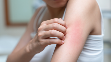 Bệnh phong ngứa là gì? Nguyên nhân, triệu chứng và cách phòng ngừa