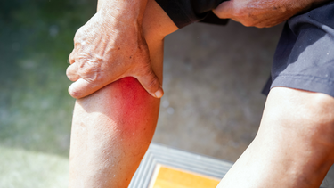 Bệnh phong thấp là gì? Nguyên nhân, triệu chứng và phương pháp điều trị