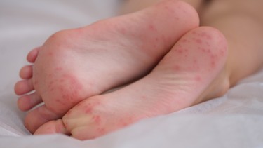 Bệnh tay chân miệng cấp độ 1: Dấu hiệu nhận biết và cách chăm sóc