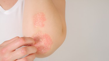 Bệnh vảy nến có lây không? Nguyên nhân và cách điều trị bệnh